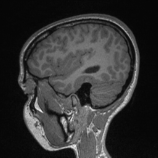 Central neurocytoma (Radiopaedia 37664-39557 Sagittal T1 24).png