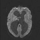 Central neurocytoma (Radiopaedia 56690-63469 Axial DWI 48).jpg
