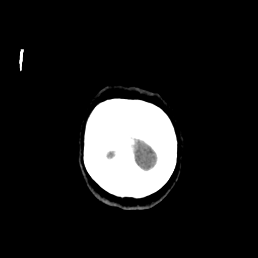 Central neurocytoma (Radiopaedia 65317-74346 Coronal non-contrast 60).png