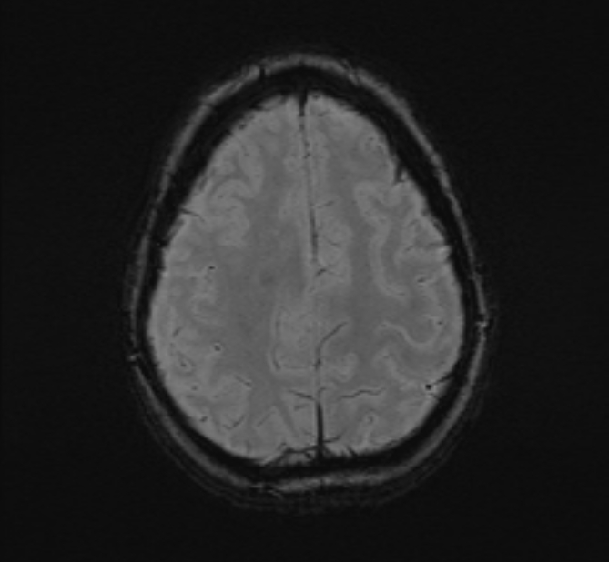 Central neurocytoma (Radiopaedia 70263-80336 Axial SWI 48).jpg