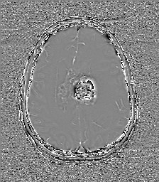 File:Central neurocytoma (Radiopaedia 84497-99872 Axial 48).jpg