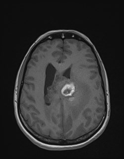 Central neurocytoma (Radiopaedia 84497-99872 Axial T1 131).jpg