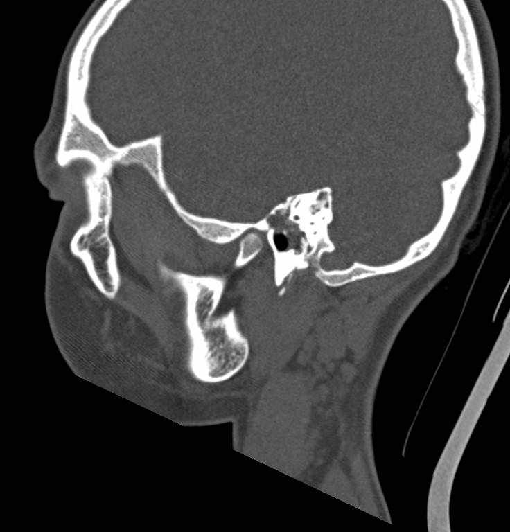 Cerebellar abscess (Radiopaedia 73727-84527 Sagittal bone window 20).jpg