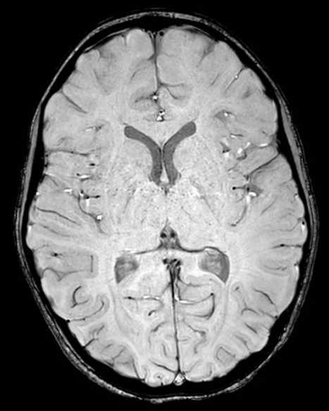 Cerebellar abscess (Radiopaedia 73727-84563 Axial SWI 39).jpg