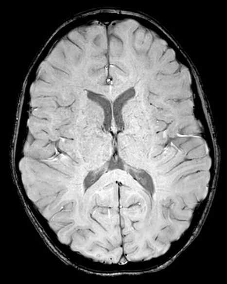 Cerebellar abscess (Radiopaedia 73727-84563 Axial SWI 42).jpg