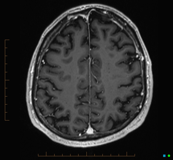 Cerebellar gangliocytoma (Radiopaedia 65377-74422 Axial T1 C+ 104).jpg