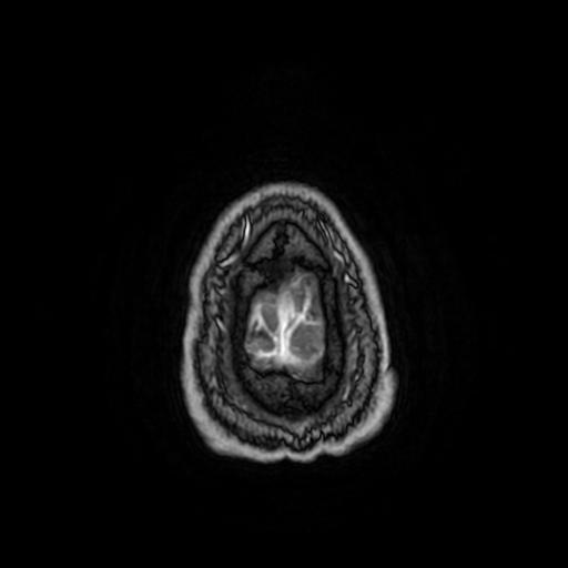 Cerebellar hemangioblastoma (Radiopaedia 88055-104622 Axial T1 C+ 165).jpg