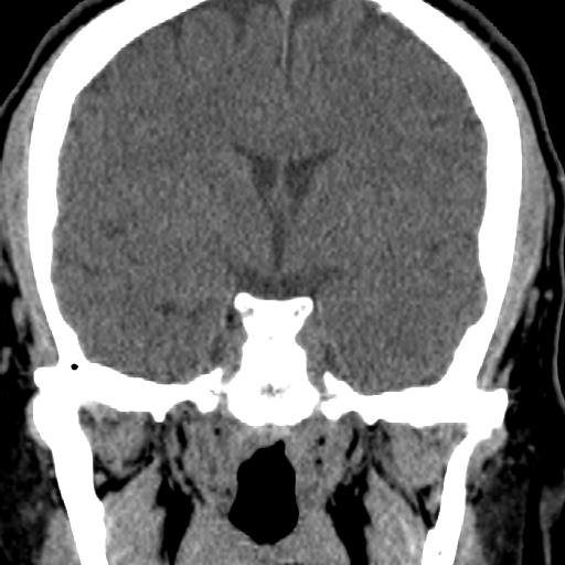 Cerebellar infarction (Radiopaedia 16625-16327 Coronal non-contrast 3).jpg