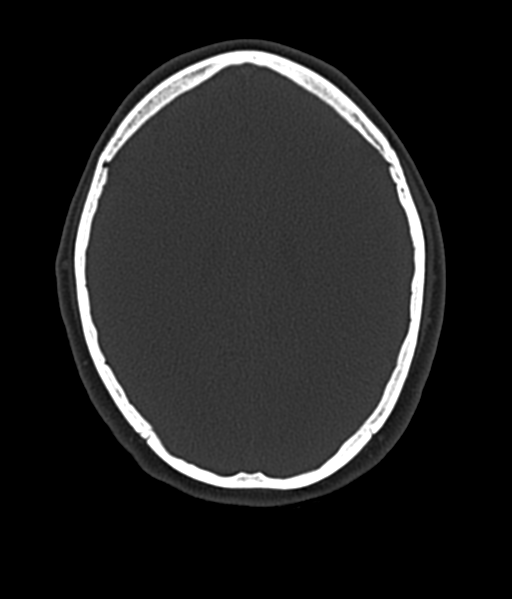 Cerebellar metastases - colorectal adenocarcinoma (Radiopaedia 40947-43652 AX Bone C- 2.0 MPR 42).png