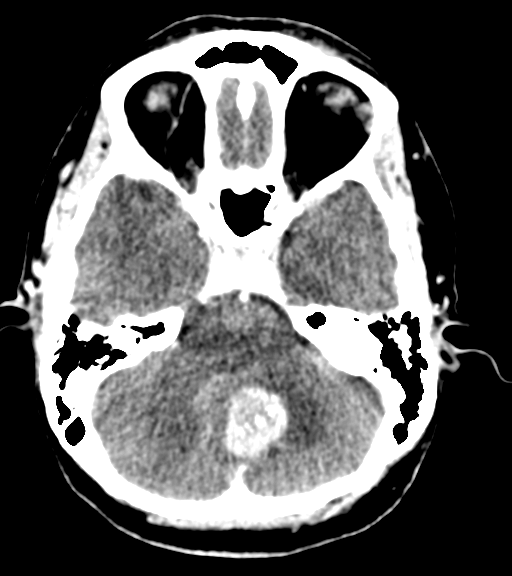Cerebellar metastases - colorectal adenocarcinoma (Radiopaedia 40947-43652 Axial C+ 13).png