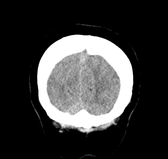 Cerebellar metastasis (Radiopaedia 54578-60812 Coronal non-contrast 56).png