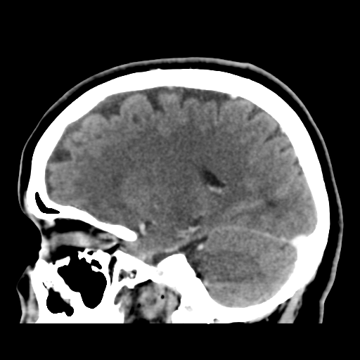 Cerebellar metastasis (cystic appearance) (Radiopaedia 41395-44258 F 21).png