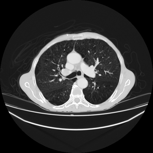 File:Cerebellar metastasis - lung tumor (Radiopaedia 69317-79150 Axial lung window 14).jpg