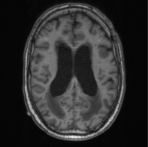 File:Cerebellar metastasis from lung adenocarcinoma (Radiopaedia 86690-102829 Axial T1 51).png