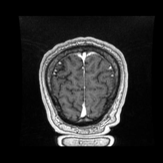 Cerebellar metastasis of pulmonary adenocarcinoma, cavernous venous malformation, and developmental venous anomaly (Radiopaedia 85827-101661 Coronal T1 C+ 19).jpg