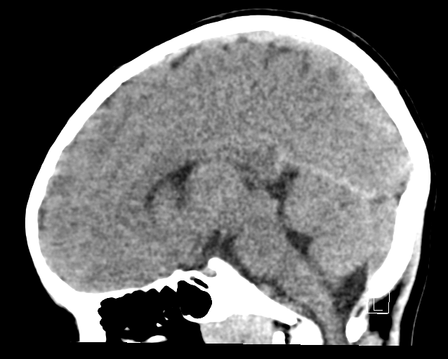 File:Cerebellar stroke (Radiopaedia 32202-33149 B 17).png