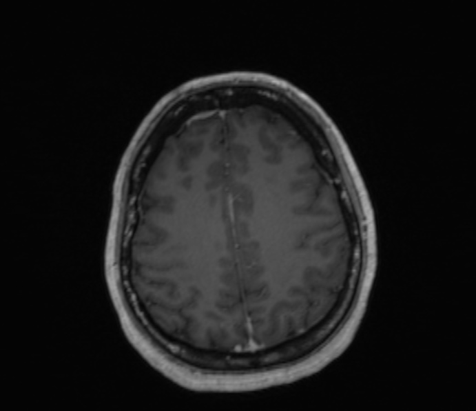 Cerebellopontine angle meningioma (Radiopaedia 35181-36715 Axial T1 C+ 17).jpg