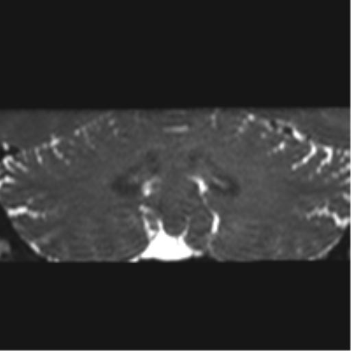 Cerebellopontine angle meningioma (Radiopaedia 48434-53348 Coronal T2 18).png