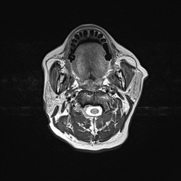 Cerebral abscess (Radiopaedia 26111-26247 Axial T2 1).jpg