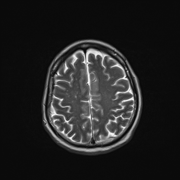 Cerebral abscess (Radiopaedia 26111-26247 Axial T2 46).jpg