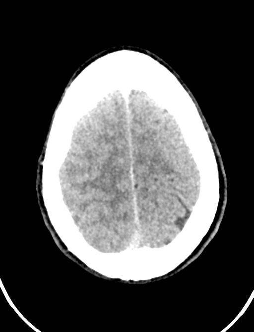 Cerebral abscess (Radiopaedia 60342-68008 Axial non-contrast 44).png