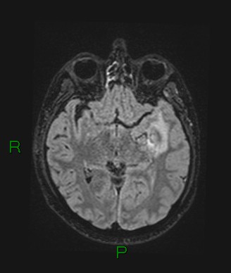 Cerebral abscess and subdural empyema (Radiopaedia 84436-99779 Axial FLAIR 48).jpg