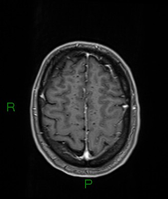 Cerebral abscess and subdural empyema (Radiopaedia 84436-99779 Axial T1 C+ 20).jpg