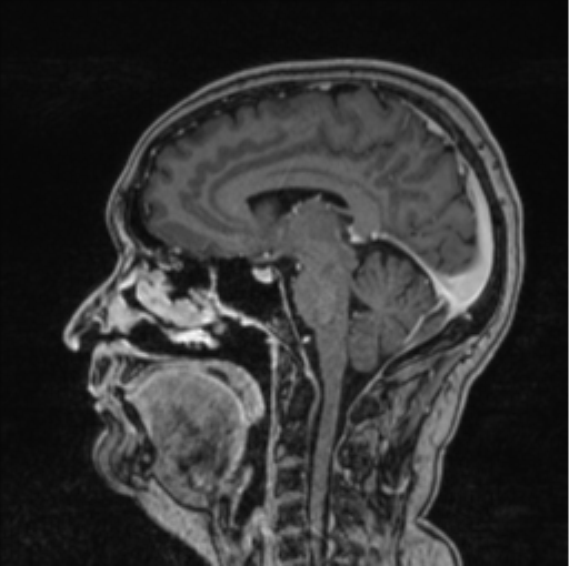 Cerebral abscess from pulmonary arteriovenous malformation (Radiopaedia 86275-102291 Sagittal T1 C+ 37).png