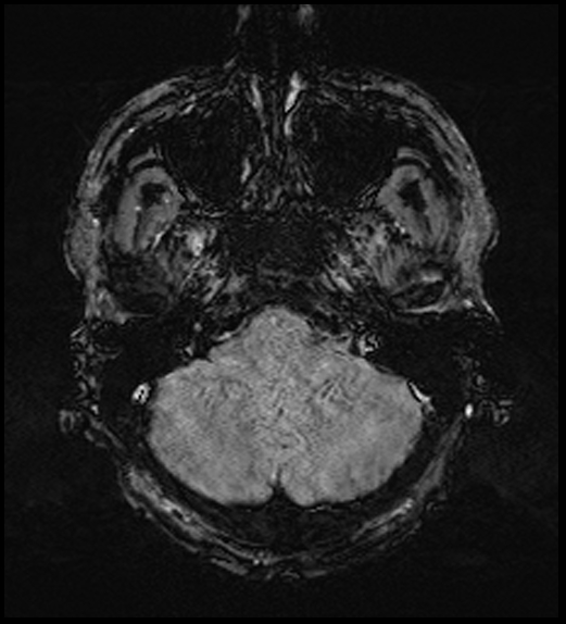 Cerebral abscess with ventriculitis (Radiopaedia 78965-91878 Axial SWI 12).jpg