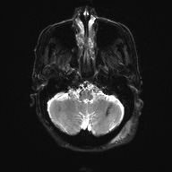 Cerebral amyloid angiopathy-related inflammation (Radiopaedia 74836-85849 Axial DWI 6).jpg