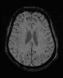 File:Cerebral amyloid angiopathy-related inflammation (Radiopaedia 74836-85849 Axial SWI 46).jpg