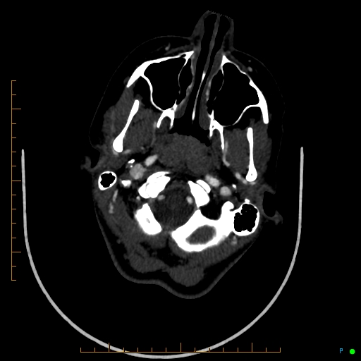 Cerebral arteriovenous malformation (AVM) (Radiopaedia 78162-90706 Axial CTA 46).jpg