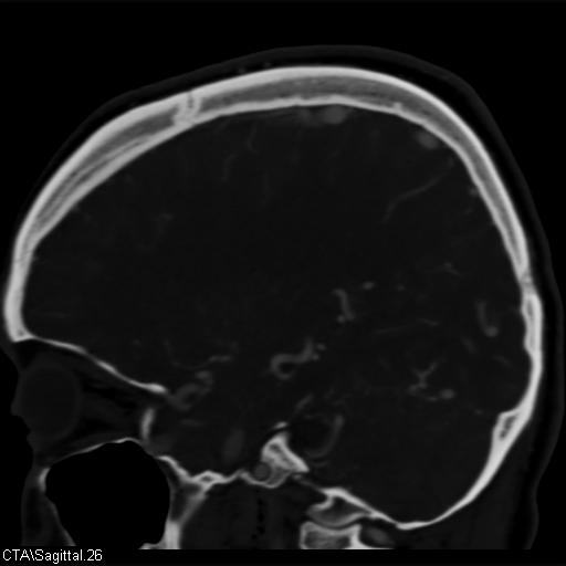 Cerebral arteriovenous malformation (Radiopaedia 28518-28759 D 23).jpg