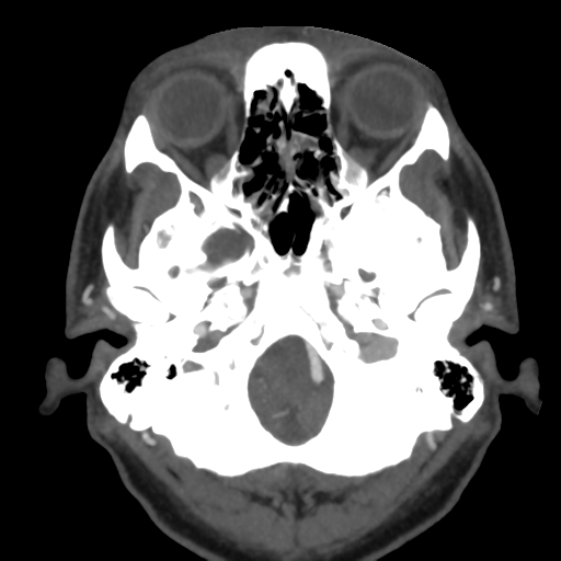 Cerebral arteriovenous malformation (Radiopaedia 39259-41505 AX CEREBRAL CTA 9).png
