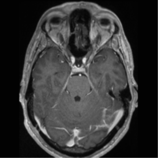 Cerebral arteriovenous malformation (Radiopaedia 55798-62372 Axial T1 C+ 25).png