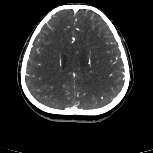 Cerebral arteriovenous malformation (Radiopaedia 73830-84645 Axial C+ delayed 30).jpg
