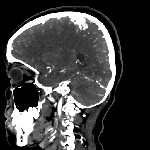 Cerebral arteriovenous malformation (Radiopaedia 73830-84645 Sagittal C+ delayed 61).jpg