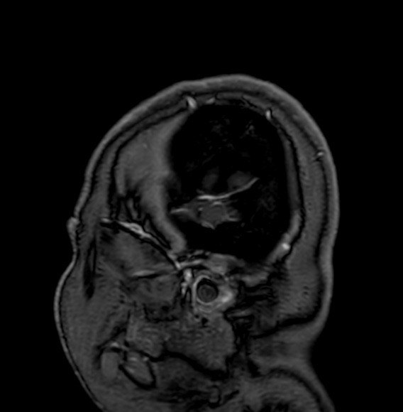 Cerebral arteriovenous malformation (Radiopaedia 74411-85746 Sagittal T1 C+ 2).jpg