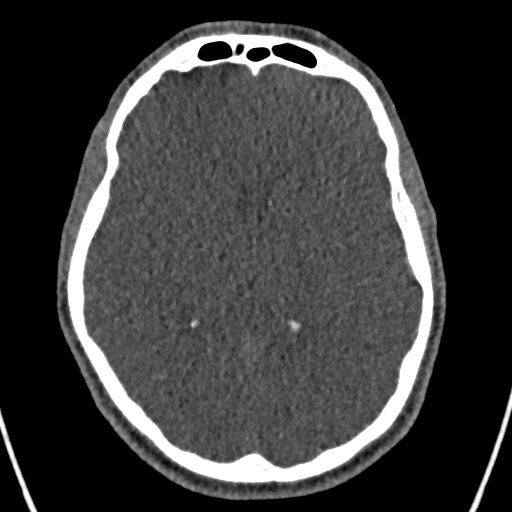 Cerebral arteriovenous malformation (Radiopaedia 78188-90746 Axial non-contrast 94).jpg