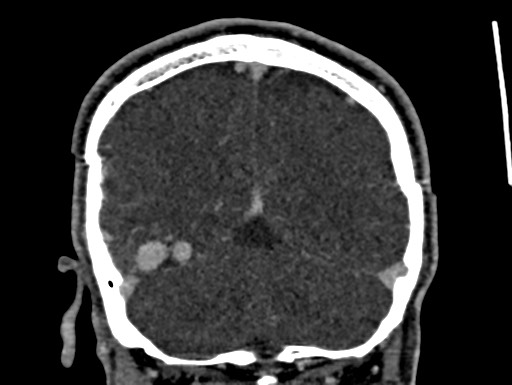 Cerebral arteriovenous malformation (Radiopaedia 78188-90746 Coronal C+ delayed 98).jpg