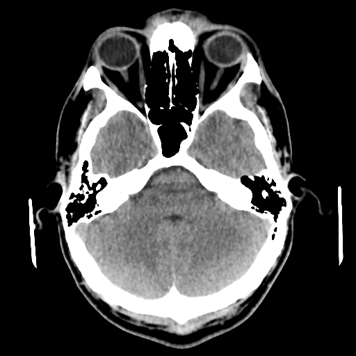 File:Cerebral arteriovenous malformation (Spetzler-Martin grade 2) (Radiopaedia 41262-44076 Axial non-contrast 16).png