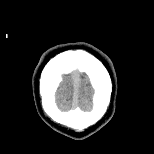 Cerebral arteriovenous malformation (Spetzler-Martin grade 2) (Radiopaedia 41262-44076 Coronal non-contrast 63).png