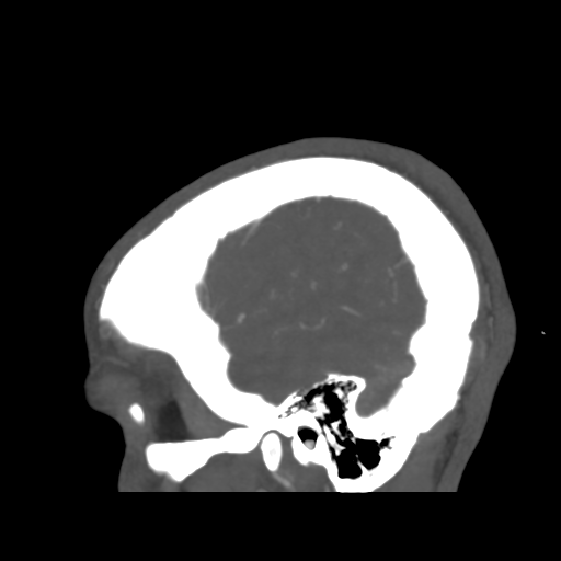 Cerebral arteriovenous malformation (Spetzler-Martin grade 2) (Radiopaedia 41262-44076 G 47).png