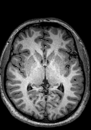 Cerebral arteriovenous malformation at posterior body of corpus callosum (Radiopaedia 74111-84925 Axial T1 147).jpg