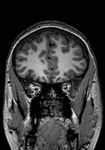 Cerebral arteriovenous malformation at posterior body of corpus callosum (Radiopaedia 74111-84925 Coronal T1 62).jpg