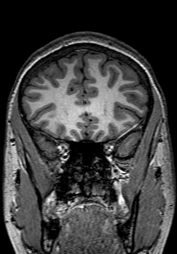 Cerebral arteriovenous malformation at posterior body of corpus callosum (Radiopaedia 74111-84925 Coronal T1 76).jpg