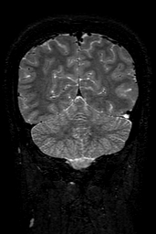 Cerebral arteriovenous malformation at posterior body of corpus callosum (Radiopaedia 74111-84925 Coronal T2 138).jpg