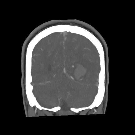 Cerebral arteriovenous malformation with lobar hemorrhage (Radiopaedia 35598-57216 C 73).jpg