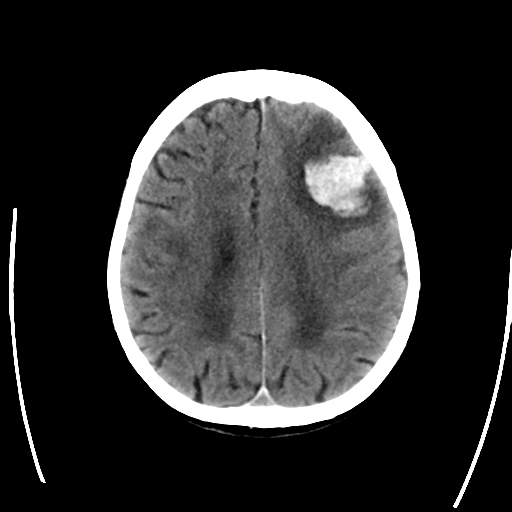 File:Cerebral arteriovenous malformation with lobar hemorrhage (Radiopaedia 44725-48512 Axial non-contrast 24).png