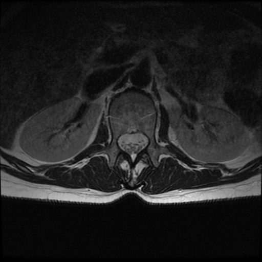 File:Cerebral autosomal dominant arteriopathy with subcortical infarcts and leukoencephalopathy (CADASIL) (Radiopaedia 41018-43763 AX T2 T11-S1 11).png